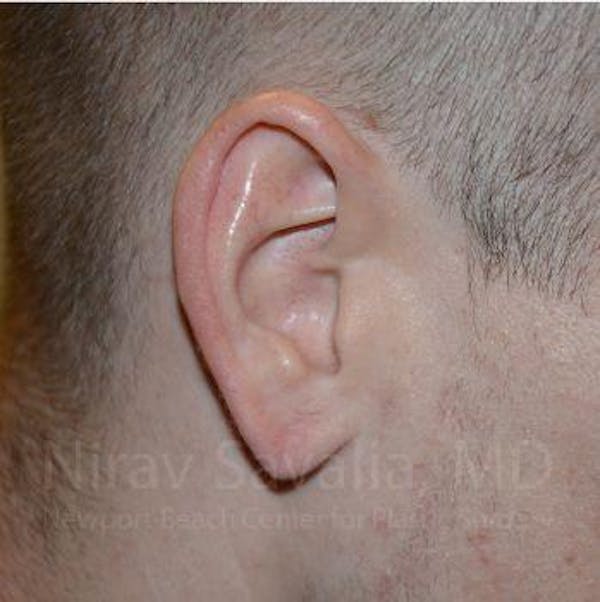 Torn Earlobe Repair / Ear Gauge Repair Before & After Gallery - Patient 1655727 - Image 2