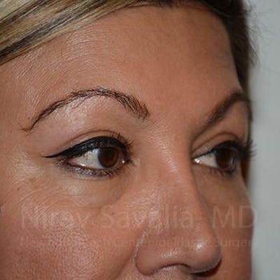 Eyelid Surgery Before & After Gallery - Patient 1655728 - Image 8