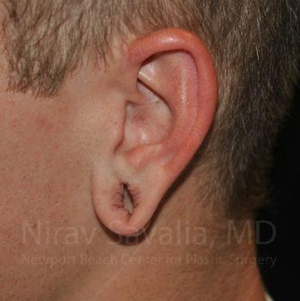 Torn Earlobe Repair / Ear Gauge Repair Before & After Gallery - Patient 1655727 - Image 3