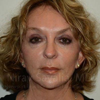 Fat Grafting to Face Before & After Gallery - Patient 1655730 - Image 2