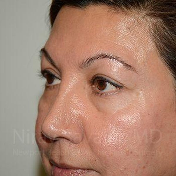 Eyelid Surgery Before & After Gallery - Patient 1655728 - Image 9
