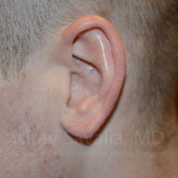 Torn Earlobe Repair / Ear Gauge Repair Gallery - Patient 1655727 - Image 4