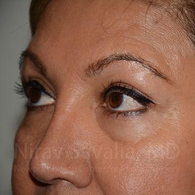 Eyelid Surgery Gallery - Patient 1655728 - Image 10