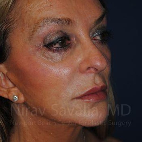Fat Grafting to Face Gallery - Patient 1655730 - Image 5
