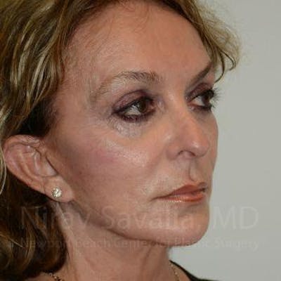 Fat Grafting to Face Before & After Gallery - Patient 1655730 - Image 6