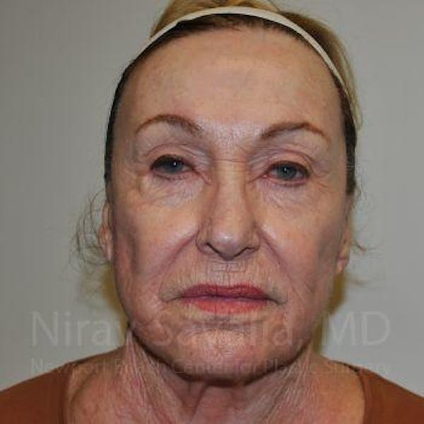 Facelift Before & After Gallery - Patient 1655786 - Image 4