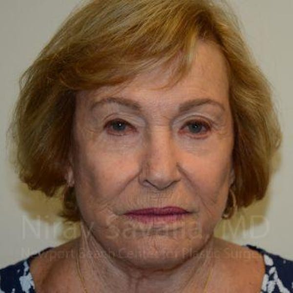 Facelift Before & After Gallery - Patient 1655786 - Image 3
