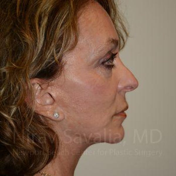 Fat Grafting to Face Gallery - Patient 1655730 - Image 8