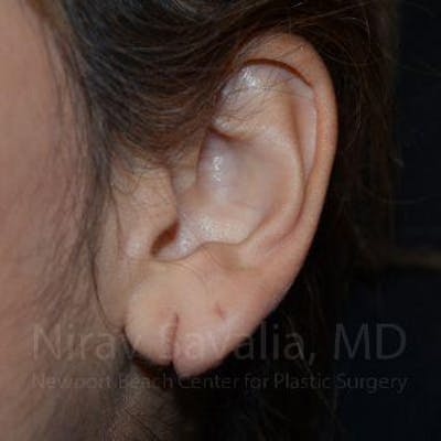 Torn Earlobe Repair / Ear Gauge Repair Before & After Gallery - Patient 1655729 - Image 1