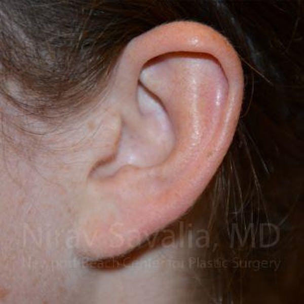 Torn Earlobe Repair / Ear Gauge Repair Before & After Gallery - Patient 1655729 - Image 2