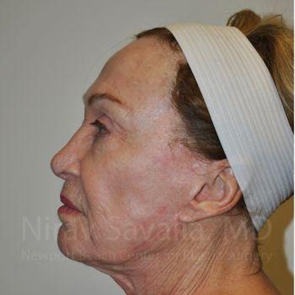 Facelift Before & After Gallery - Patient 1655786 - Image 5