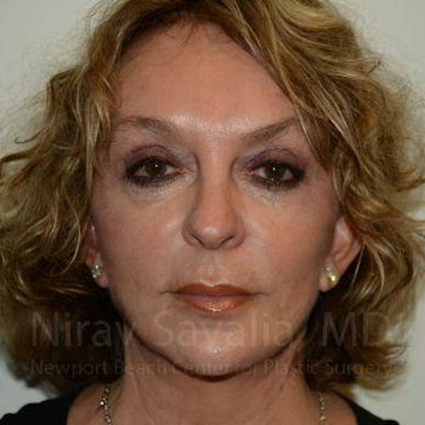 Eyelid Surgery Before & After Gallery - Patient 1655789 - Image 2