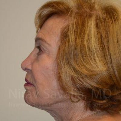 Facelift Before & After Gallery - Patient 1655786 - Image 6