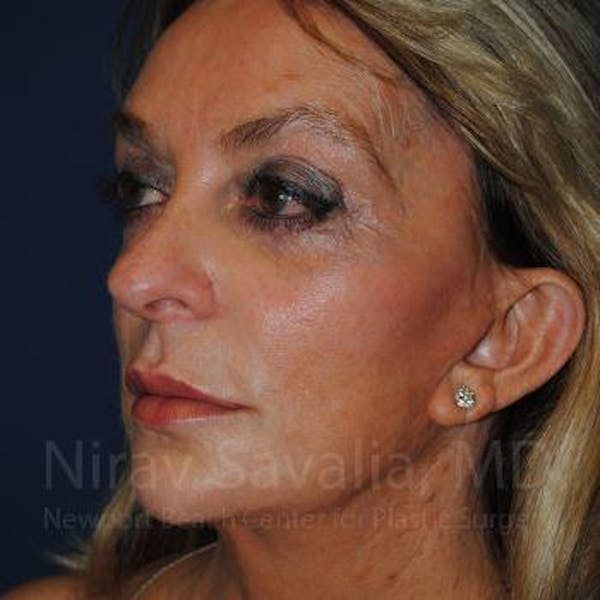 Eyelid Surgery Before & After Gallery - Patient 1655789 - Image 3