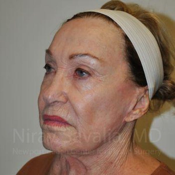 Facelift Before & After Gallery - Patient 1655786 - Image 7
