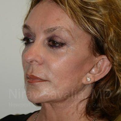 Eyelid Surgery Before & After Gallery - Patient 1655789 - Image 4