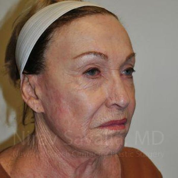 Facelift Before & After Gallery - Patient 1655786 - Image 9