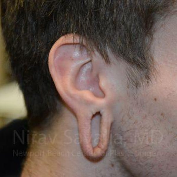 Torn Earlobe Repair / Ear Gauge Repair Before & After Gallery - Patient 1655788 - Image 1