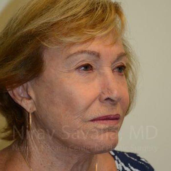 Facelift Before & After Gallery - Patient 1655786 - Image 10
