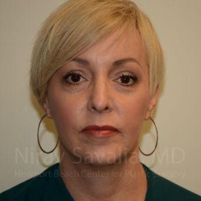 Fat Grafting to Face Before & After Gallery - Patient 1655787 - Image 1