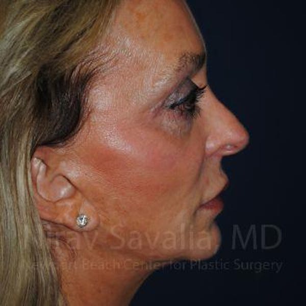 Eyelid Surgery Before & After Gallery - Patient 1655789 - Image 7