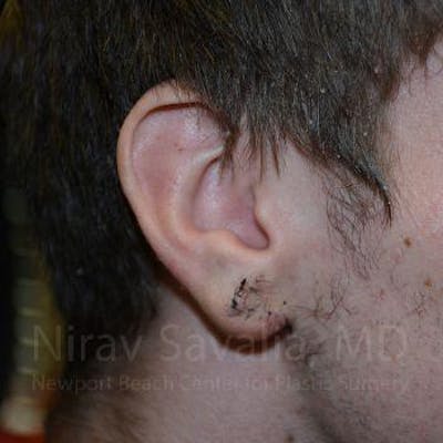 Torn Earlobe Repair / Ear Gauge Repair Before & After Gallery - Patient 1655788 - Image 2