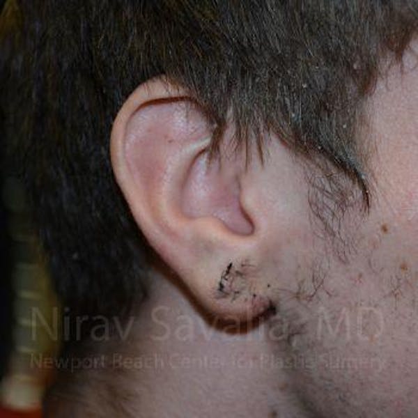 Torn Earlobe Repair / Ear Gauge Repair Before & After Gallery - Patient 1655788 - Image 2