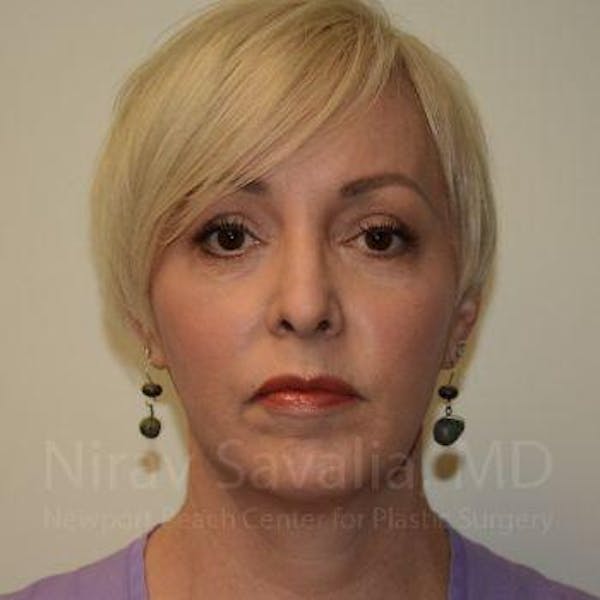 Fat Grafting to Face Gallery - Patient 1655787 - Image 2