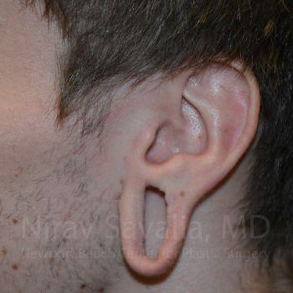 Torn Earlobe Repair / Ear Gauge Repair Before & After Gallery - Patient 1655788 - Image 3