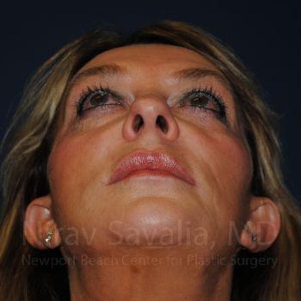 Eyelid Surgery Before & After Gallery - Patient 1655789 - Image 9