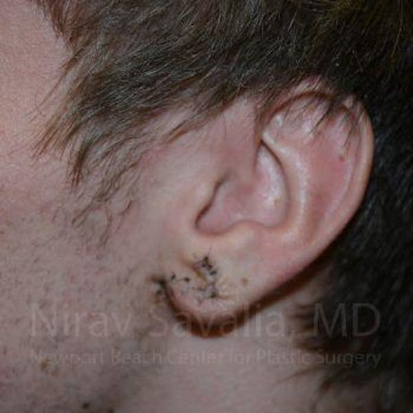 Torn Earlobe Repair / Ear Gauge Repair Before & After Gallery - Patient 1655788 - Image 4