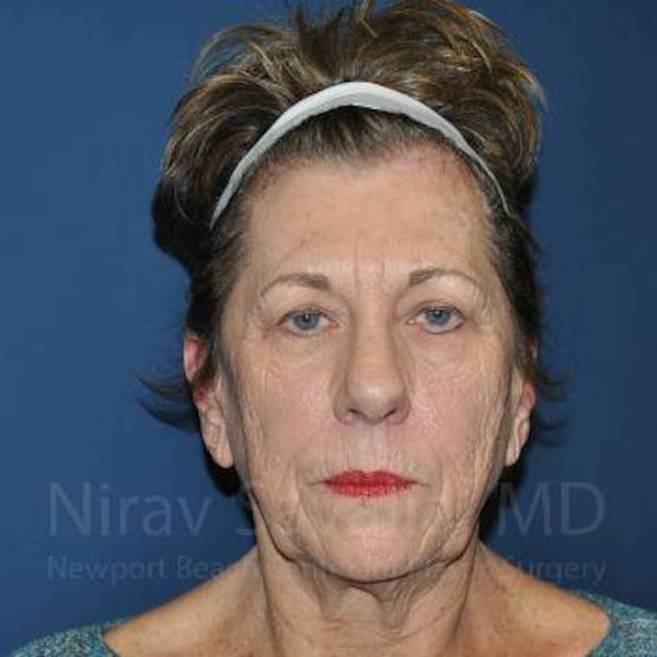 Facelift Before & After Gallery - Patient 1655791 - Image 4