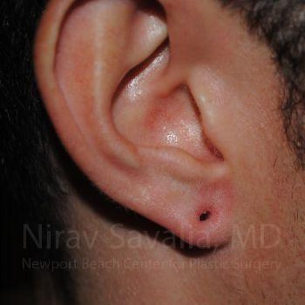 Torn Earlobe Repair / Ear Gauge Repair Before & After Gallery - Patient 1655790 - Image 1