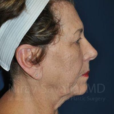 Facelift Before & After Gallery - Patient 1655791 - Image 1
