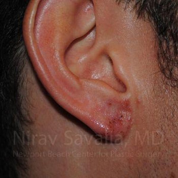 Torn Earlobe Repair / Ear Gauge Repair Before & After Gallery - Patient 1655790 - Image 2