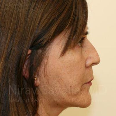 Eyelid Surgery Before & After Gallery - Patient 1655793 - Image 4