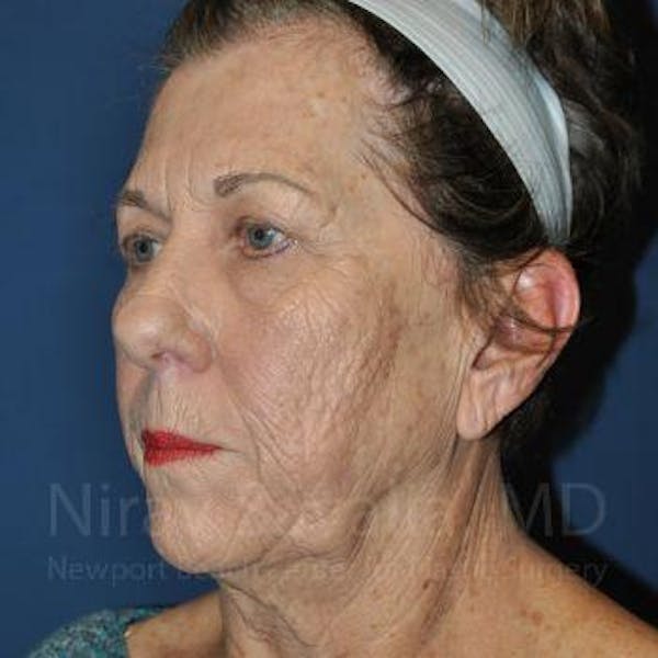 Facelift Before & After Gallery - Patient 1655791 - Image 7