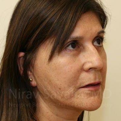 Eyelid Surgery Before & After Gallery - Patient 1655793 - Image 6