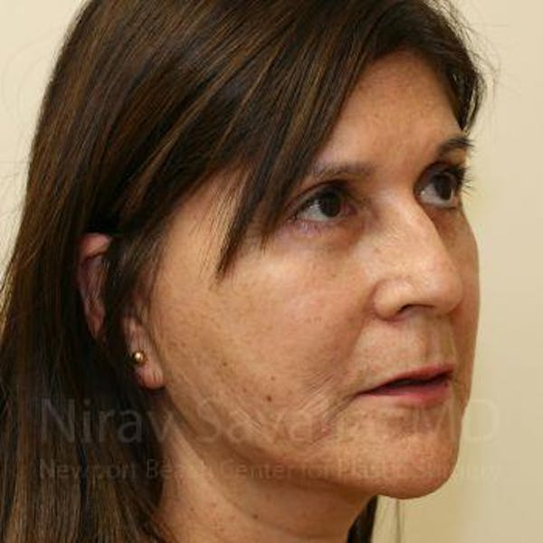 Eyelid Surgery Before & After Gallery - Patient 1655793 - Image 6