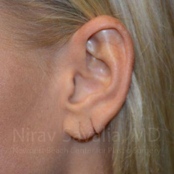 Torn Earlobe Repair / Ear Gauge Repair Gallery - Patient 1655792 - Image 1