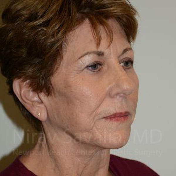 Facelift Before & After Gallery - Patient 1655791 - Image 10