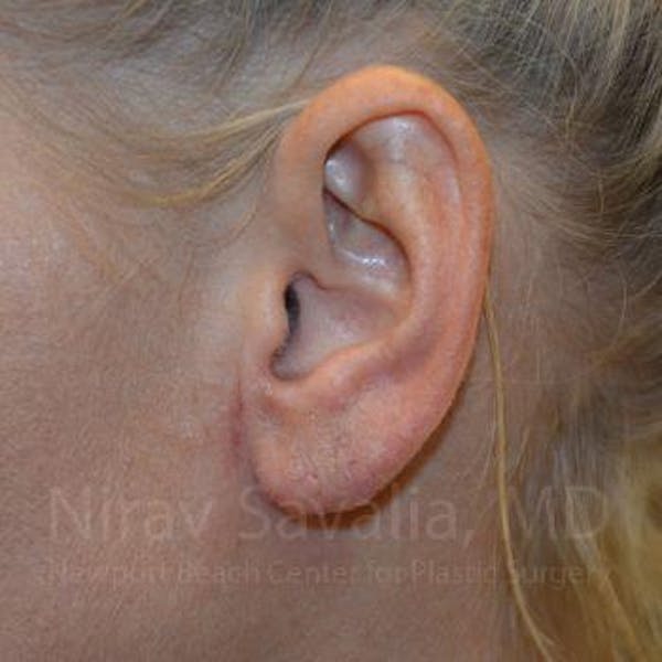 Torn Earlobe Repair / Ear Gauge Repair Before & After Gallery - Patient 1655792 - Image 2