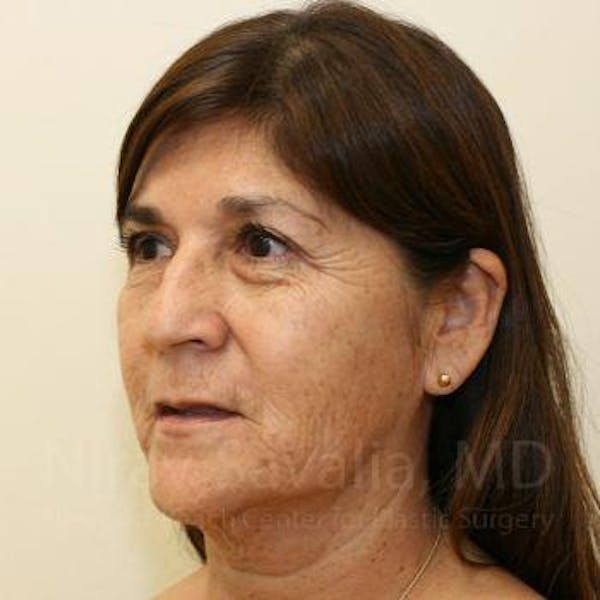 Eyelid Surgery Before & After Gallery - Patient 1655793 - Image 9