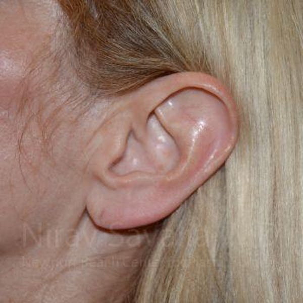 Torn Earlobe Repair / Ear Gauge Repair Before & After Gallery - Patient 1655794 - Image 1
