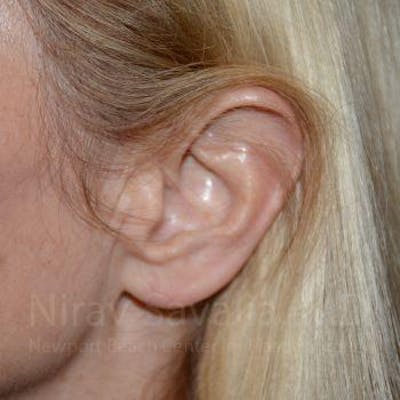 Torn Earlobe Repair / Ear Gauge Repair Gallery - Patient 1655794 - Image 2