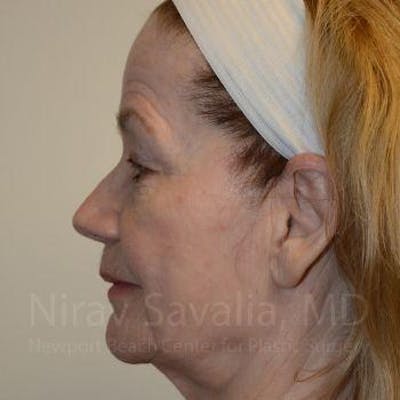 Facelift Before & After Gallery - Patient 1655795 - Image 6