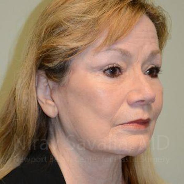 Facelift Before & After Gallery - Patient 1655795 - Image 8