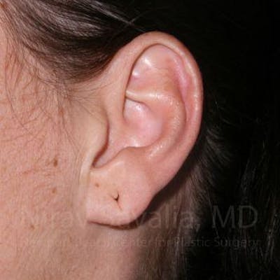 Torn Earlobe Repair / Ear Gauge Repair Before & After Gallery - Patient 1655797 - Image 1