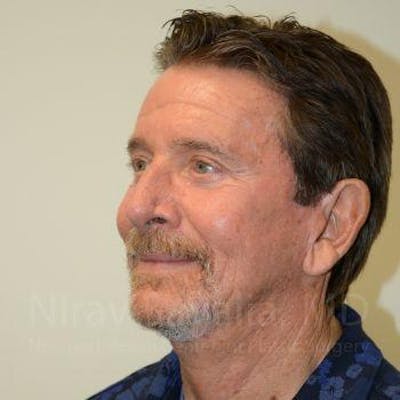 Eyelid Surgery Before & After Gallery - Patient 1655796 - Image 8