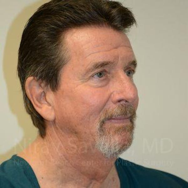 Eyelid Surgery Before & After Gallery - Patient 1655796 - Image 9